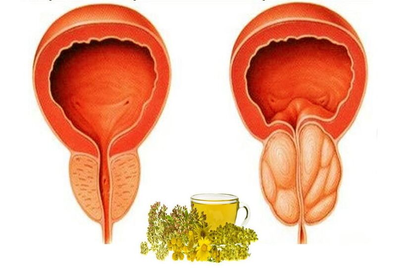 Healthy and sore prostate
