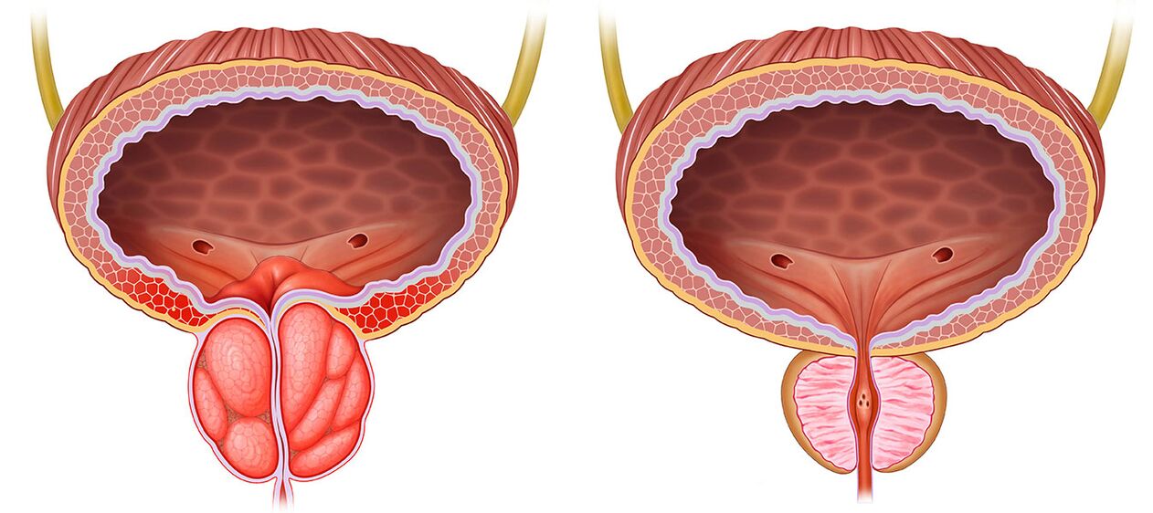 inflamed and healthy prostate after using Predstonorm capsule